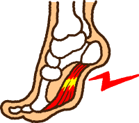 足底筋膜炎のイラスト