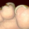 外反母趾で巻き爪になって靴を履くと痛い…外反母趾と巻き爪に共通する原因と対策
