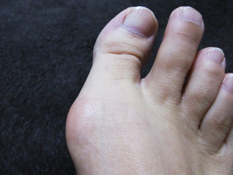 外反母趾のインソールで男性用はある 男性に外反母趾について