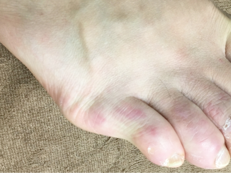 内反小趾で小指にタコができて痛い…改善方法はある？