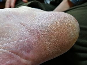 かかとにタコができる原因は靴かも！？かかとにできるタコについて
